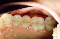 New cosmetic composite restorations