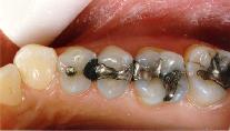 Old amalgam fillings