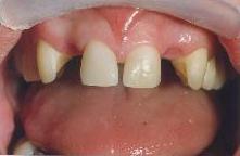 Missing teeth