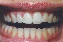 After dental bonding