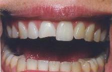 Chipped tooth
