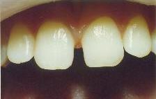 Space between front teeth
