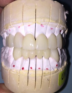 porcelain crowns