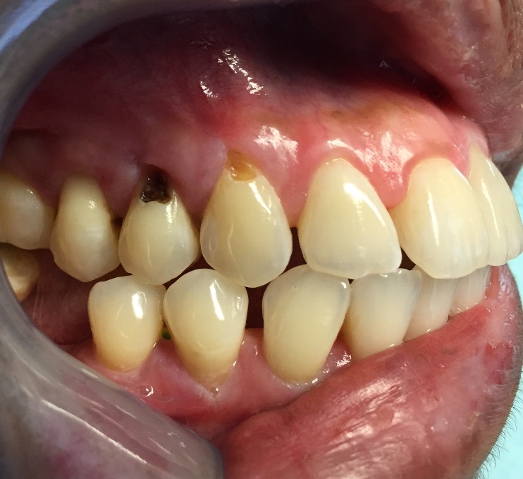 Cavity of the day | Dr. Gentry