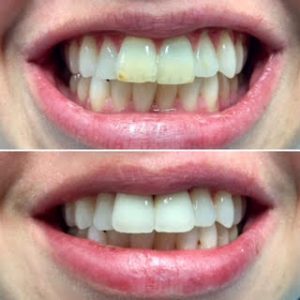 dental crowns-before-after