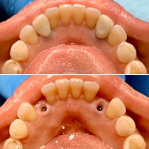 dental implants to replace missing teeth