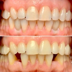 dental implants before after arlington va