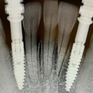 dental implants x-ray