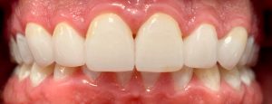 porcelain veneers