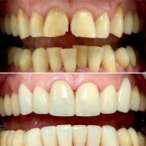 Before & After Photos, Cracked Tooth Repair Gallery