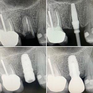 dental implant