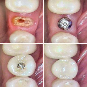 dental implant