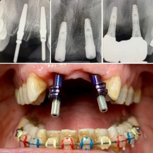 dental implants