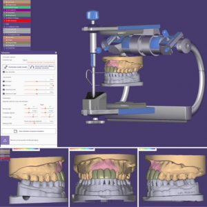 implant bridge computer design 