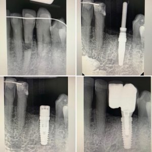 dental implant placement