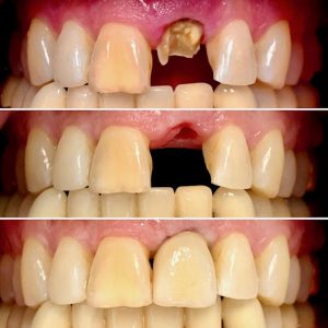 broken tooth dental implant 