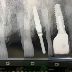 dental implant 