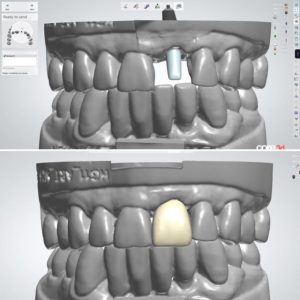 dental implant design