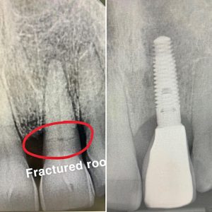 dental implant