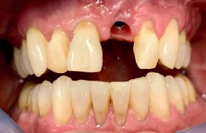 dental implant