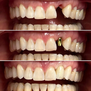 dental implant